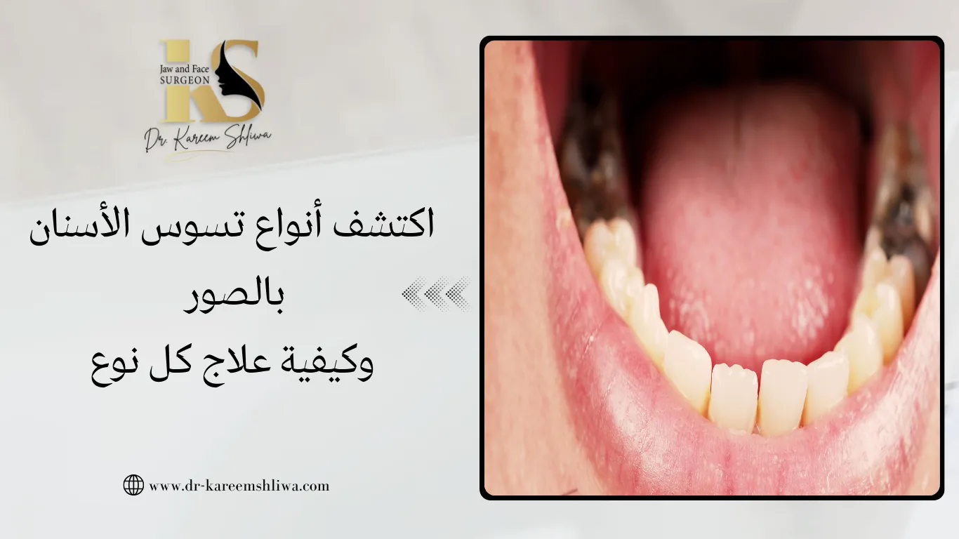 اكتشف أنواع تسوس الأسنان بالصور وكيفية علاج كل نوع | دكتور كريم شيلوة
