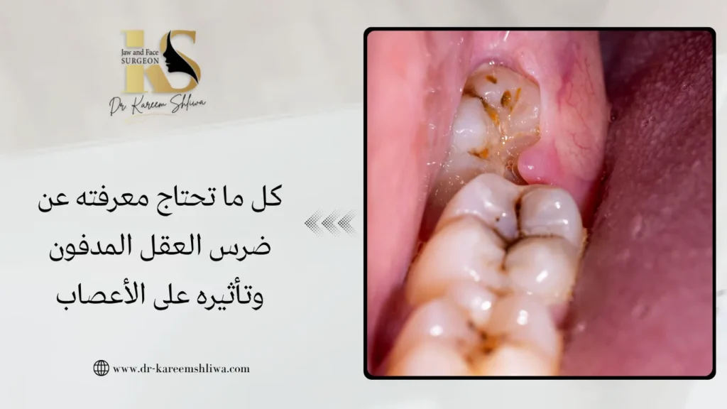 كل ما تحتاج معرفته عن ضرس العقل المدفون وتأثيره على الأعصاب