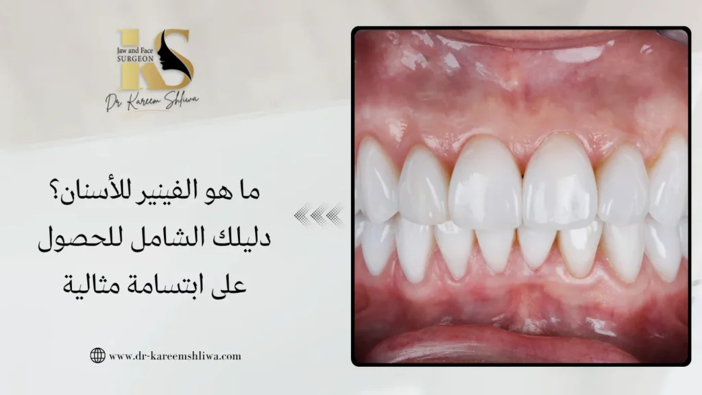 ما هو الفينير للأسنان؟ دليلك الشامل للحصول على ابتسامة مثالية