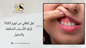 تورم اللثة