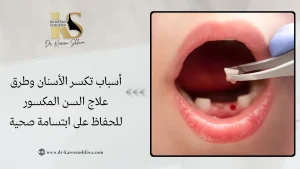 أسباب تكسر الأسنان وطرق علاج السن المكسور