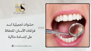 حشوات تجميلية لسد فراغات الأسنان