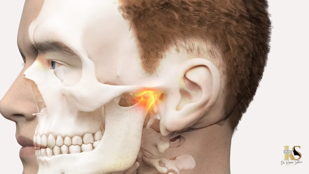 متلازمة المفصل الصدغي الفكي