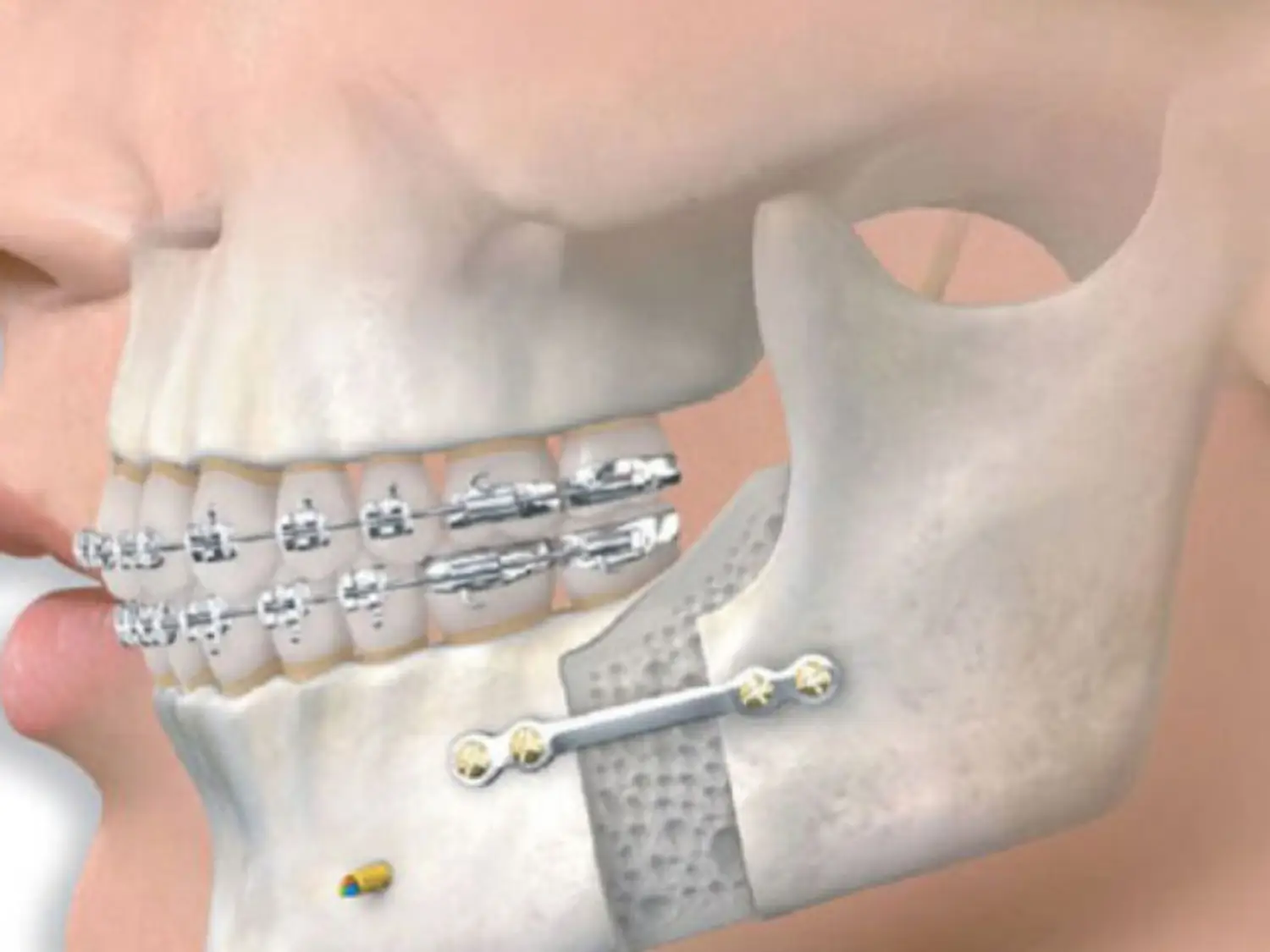 التقويم الجراحي للفكين