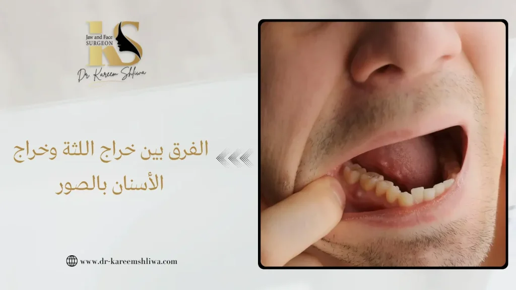 الفرق بين خراج اللثة خراج الأسنان بالصور