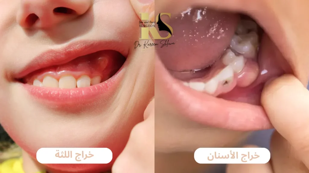 الفرق بين خراج اللثة وخراج الأسنان