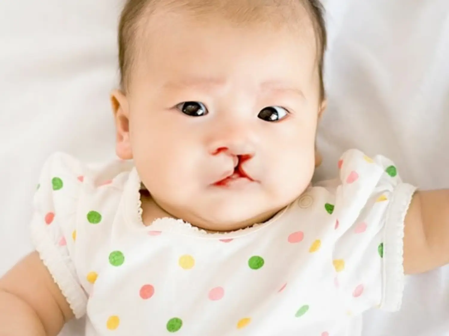 تجميل الشفة الأرنبية