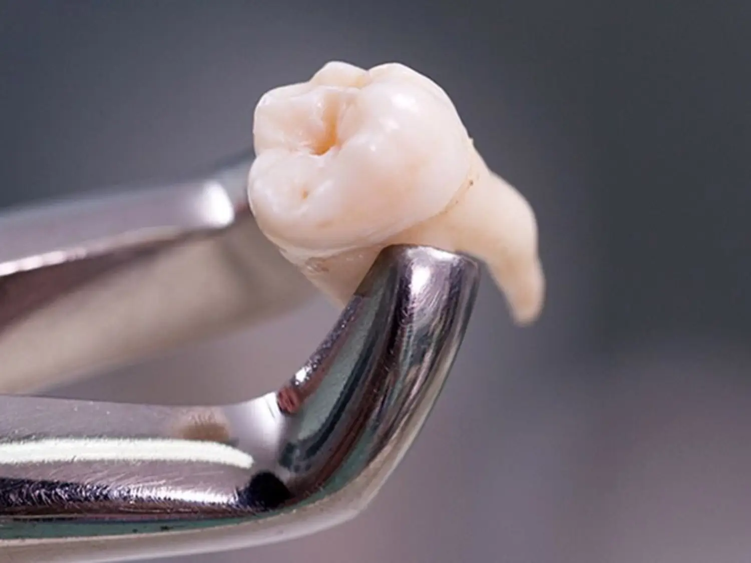 خلع ضرس العقل