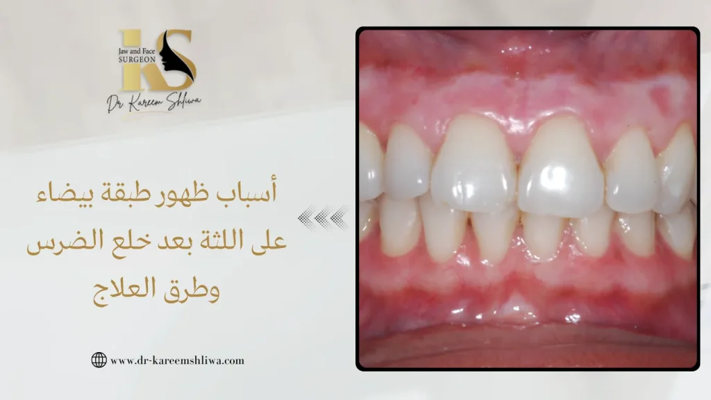 ظهور طبقة بيضاء على اللثة