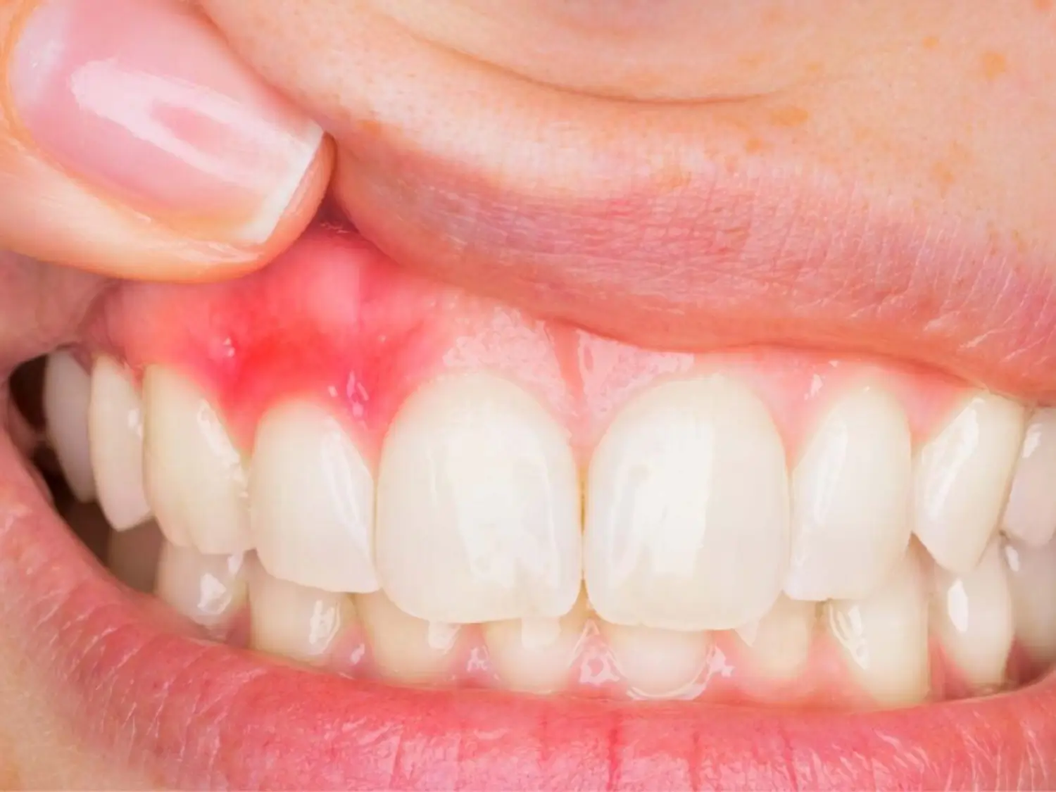 علاج الاكياس الدهنية وأورام الفكين