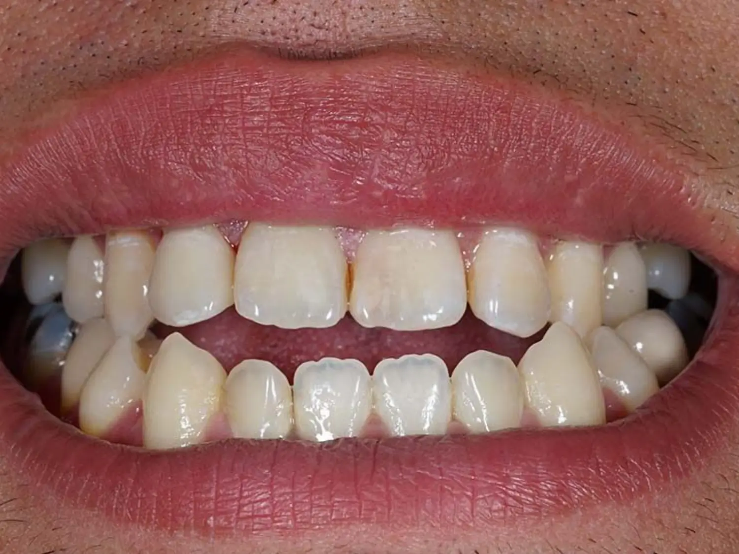 علاج العضة المفتوحة