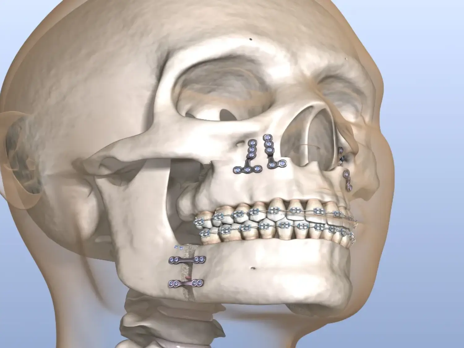 علاج كسور الوجه والفكين