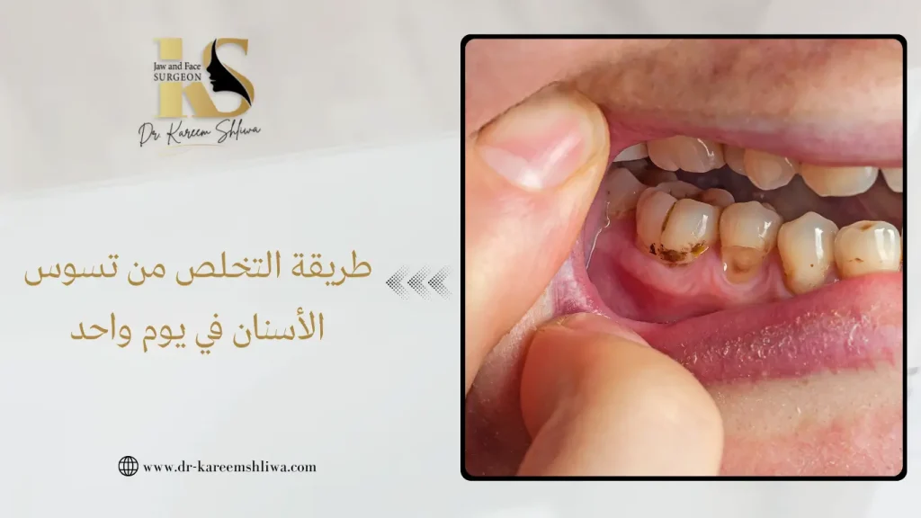 طريقة التخلص من تسوس الأسنان في يوم واحد