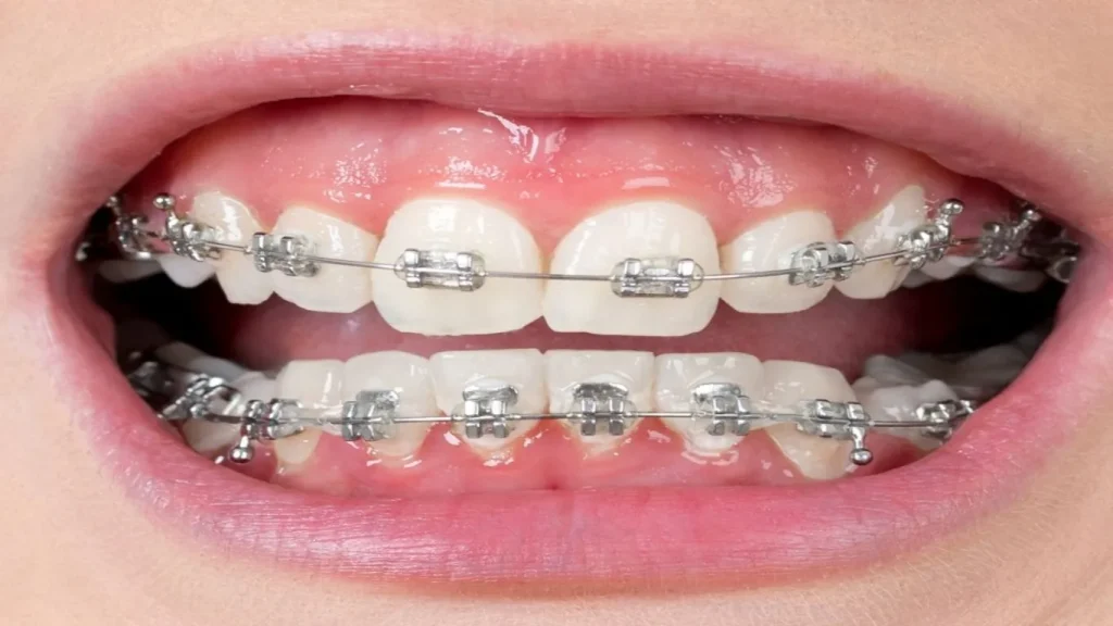 تقويم الأسنان المعدني