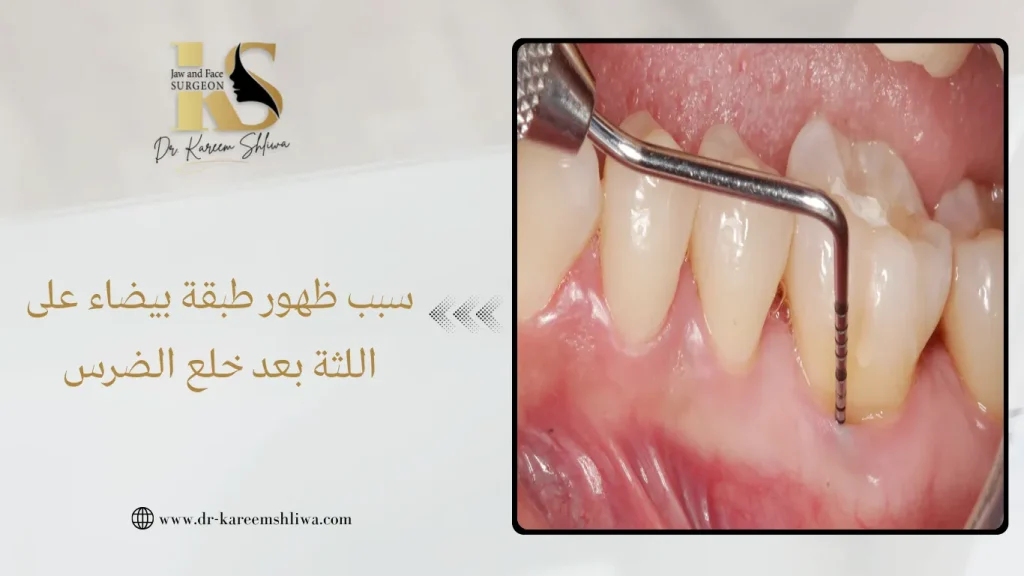 سبب ظهور طبقة بيضاء على اللثة بعد خلع الضرس