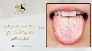 أسباب الفطريات في الفم
