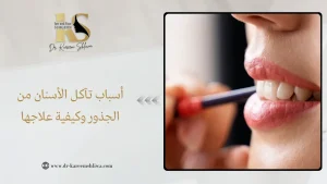 أسباب تآكل الأسنان من الجذور
