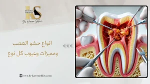 انواع حشو العصب