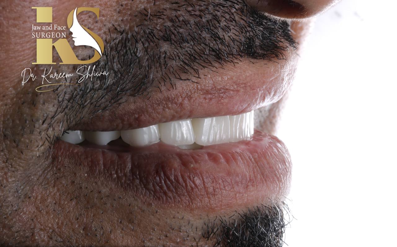 إعادة تأهيل الفك - بعد العلاج