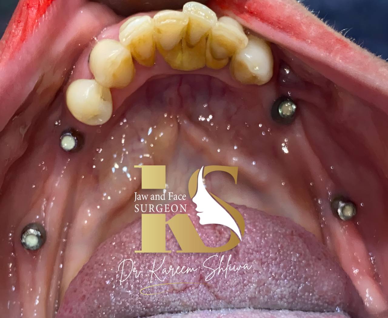 إعادة تأهيل الفك - الحالة الثانية قبل العلاج