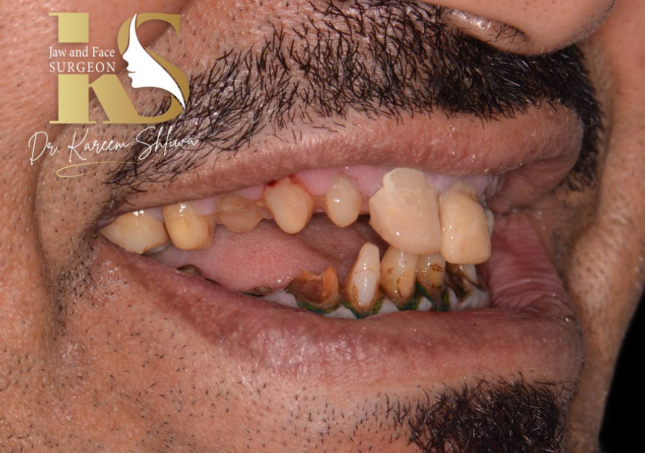 إعادة تأهيل الفك - قبل العلاج